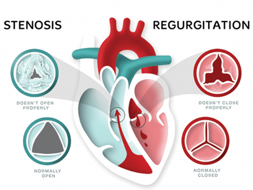 Ayurvedic Treatment For Heart Valve Stenosis